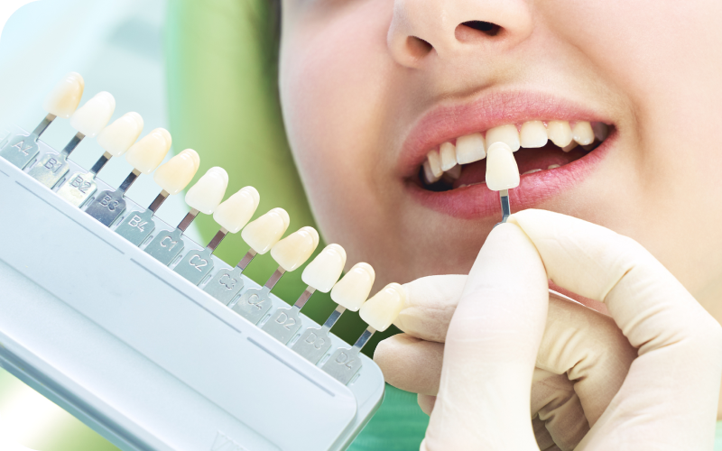 ホワイトニング